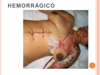HEMORRÁGICO
 