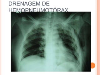 DRENAGEM DE
HEMOPNEUMOTÓRAX
 
