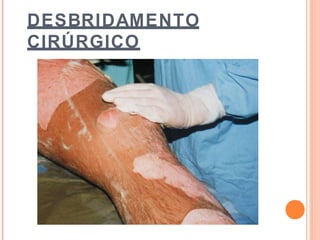 DESBRIDAMENTO
CIRÚRGICO
 