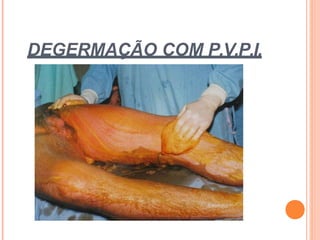 DEGERMAÇÃO COM P.V.P.I.
 