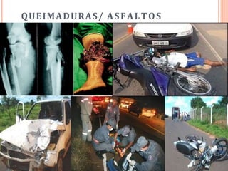 QUEIMADURAS/ ASFALTOS
 
