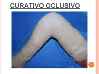 CURATIVO OCLUSIVO
 