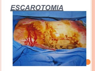 ESCAROTOMIA
 