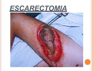 ESCARECTOMIA
 