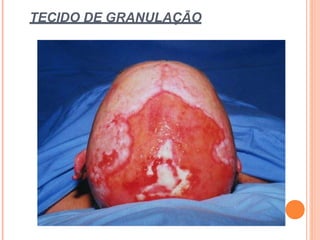 TECIDO DE GRANULAÇÃO
 