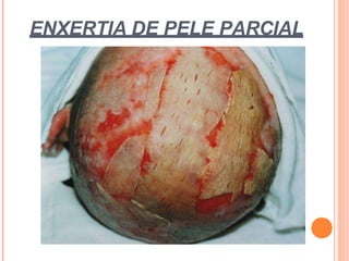 ENXERTIA DE PELE PARCIAL
 