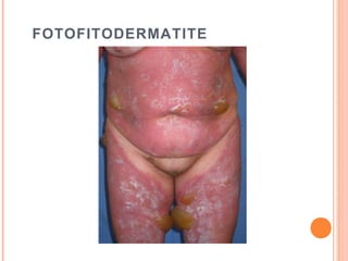 FOTOFITODERMATITE
 