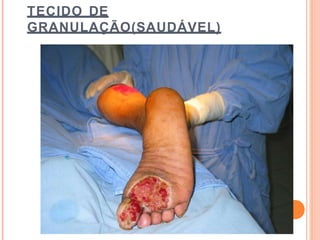 TECIDO DE
GRANULAÇÃO(SAUDÁVEL)
 