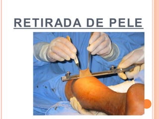 RETIRADA DE PELE
 