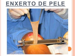 ENXERTO DE PELE
 