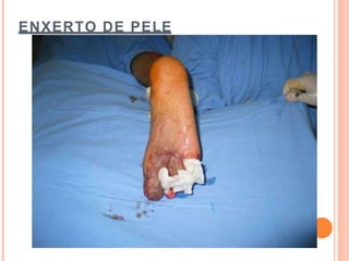ENXERTO DE PELE
 