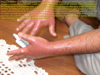 Fomos ao médico e a princípio ele estava em dúvida se o problema era alergia/intoxicação ou queimadura, porque o sintoma não estava claro o suficiente e eu também não lembrei de comentar sobre a limonada por ter lavado muito bem as minhas mãos e estar desconfiado de que o jogo de vôlei teria desencadeado este sintoma. Fui medicado com uma injeção anti-alérgica e pomada para queimadura, mas quando eu e minha esposa estávamos saindo do hospital as mãos da minha esposa começaram a apresentar manchas vermelhas, foi neste momento que nós lembramos da limonada e voltamos para o consultório do médico para relator o ocorrido com a limonada, então o médico confirmou que o limão provocou este sintoma e mandou eu ir para casa e continuar aplicando a pomada para queimadura. 