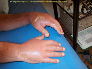 No segundo dia (10/01/2006) minhas mãos amanheceram com bolhas. 