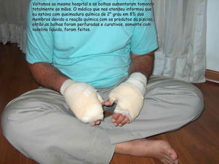 Voltamos ao mesmo hospital e as bolhas aumentaram tomando totalmente as mãos. O médico que nos atendeu informou que eu estava com queimadura química de 2° grau em 8% dos membros devido a reação química com os produtos da piscina, então as bolhas foram perfuradas e curativos, somente com vaselina líquida, foram feitos. 