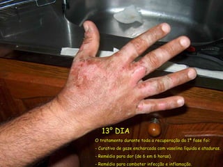 13° DIA O tratamento durante toda a recuperação da 1ª fase foi: Curativo de gaze encharcada com vaselina líquida e ataduras. Remédio para dor (de 6 em 6 horas). Remédio para combater infecção e inflamação. 