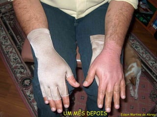 UM MÊS DEPOIS Edson Martins de Abreu 