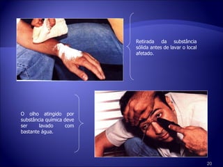 O olho atingido por substância química deve ser lavado com bastante água. Retirada da substância sólida antes de lavar o local afetado. 