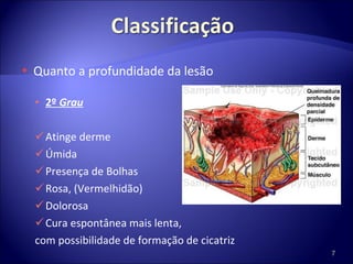 Quanto a profundidade da lesão 2º  Grau Atinge derme Úmida Presença de Bolhas Rosa, (Vermelhidão) Dolorosa Cura espontânea mais lenta,  com possibilidade de formação de cicatriz 