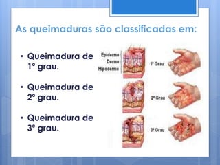 As queimaduras são classificadas em:
• Queimadura de
1º grau.
• Queimadura de
2º grau.
• Queimadura de
3º grau.
 