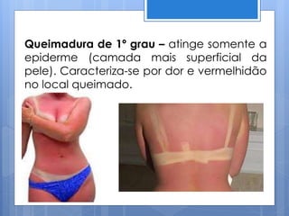 Queimadura de 1º grau – atinge somente a
epiderme (camada mais superficial da
pele). Caracteriza-se por dor e vermelhidão
no local queimado.
 