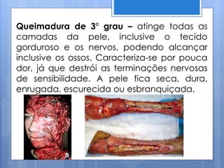 Queimadura de 3º grau – atinge todas as
camadas da pele, inclusive o tecido
gorduroso e os nervos, podendo alcançar
inclusive os ossos. Caracteriza-se por pouca
dor, já que destrói as terminações nervosas
de sensibilidade. A pele fica seca, dura,
enrugada, escurecida ou esbranquiçada.
 