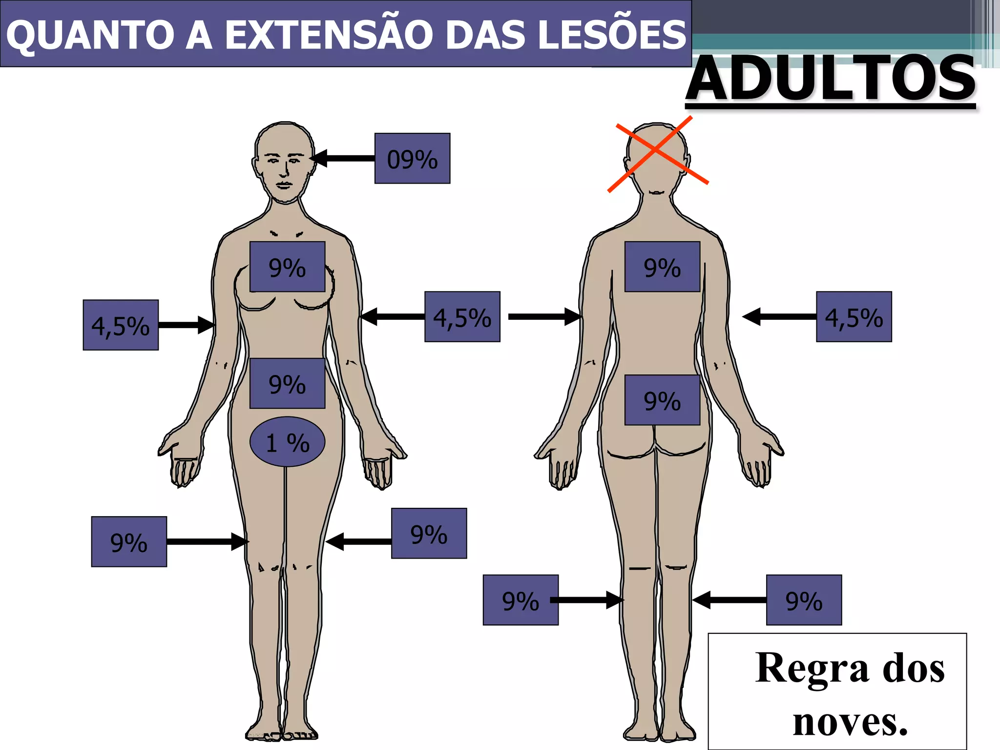 09%
4,5%
9%
9%
9%
9%
4,5%
1 %
9%
9%
9% 9%
4,5%
ADULTOS
Regra dos
noves.
QUANTO A EXTENSÃO DAS LESÕES
 