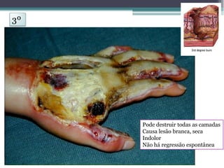 Pode destruir todas as camadas
Causa lesão branca, seca
Indolor
Não há regressão espontânea
3º
 