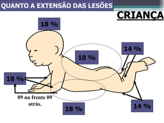 18 %
18 %
14 %
18 %
18 % 14 %
CRIANÇA
QUANTO A EXTENSÃO DAS LESÕES
09 na frente 09
atrás.
 