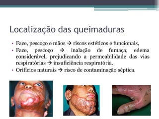 Localização das queimaduras
• Face, pescoço e mãos  riscos estéticos e funcionais,
• Face, pescoço  inalação de fumaça, edema
considerável, prejudicando a permeabilidade das vias
respiratórias  insuficiência respiratória.
• Orifícios naturais  risco de contaminação séptica.
 