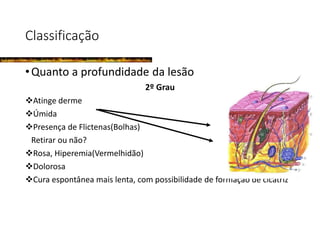 Classificação
•Quanto a profundidade da lesão
2º Grau
Atinge derme
Úmida
Presença de Flictenas(Bolhas)
Retirar ou não?
Rosa, Hiperemia(Vermelhidão)
Dolorosa
Cura espontânea mais lenta, com possibilidade de formação de cicatriz
 
