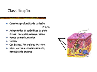  Quanto a profundidade da lesão
3º Grau
 Atinge todos os apêndices da pele
Ossos , musculos, nervos , vasos
 Pouca ou nenhuma dor
 Úmida
 Cor Branca, Amarela ou Marrom
 Não cicatriza espontaneamente,
necessita de enxerto
Classificação
 