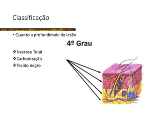 Classificação
• Quanto a profundidade da lesão
4º Grau
Necrose Total
Carbonização
Tecido negro
 