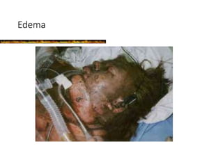 Edema
 