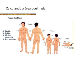 Calculando a área queimada
• Regra dos Nove
 Rápido
 Prático
 Fácil de
memorizar
 Pouco preciso
 