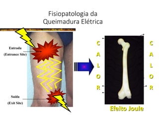 Fisiopatologia da
Queimadura Elétrica
Entrada
(Entrance Site)
Saída
(Exit Site)
C
A
L
O
R
C
A
L
O
R
Efeito Joule
 
