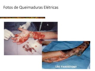 Fotos de Queimaduras Elétricas
 