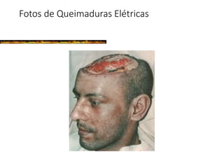 Fotos de Queimaduras Elétricas
 