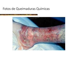 Fotos de Queimaduras Químicas
 