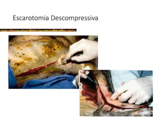 Escarotomia Descompressiva
 