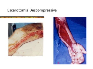 Escarotomia Descompressiva
 