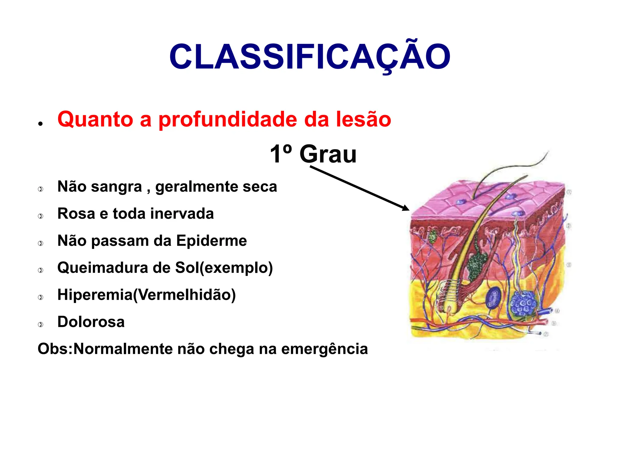 CLASSIFICAÇÃO
● Quanto a profundidade da lesão
1º Grau
 Não sangra , geralmente seca
 Rosa e toda inervada
 Não passam da Epiderme
 Queimadura de Sol(exemplo)
 Hiperemia(Vermelhidão)
 Dolorosa
Obs:Normalmente não chega na emergência
 