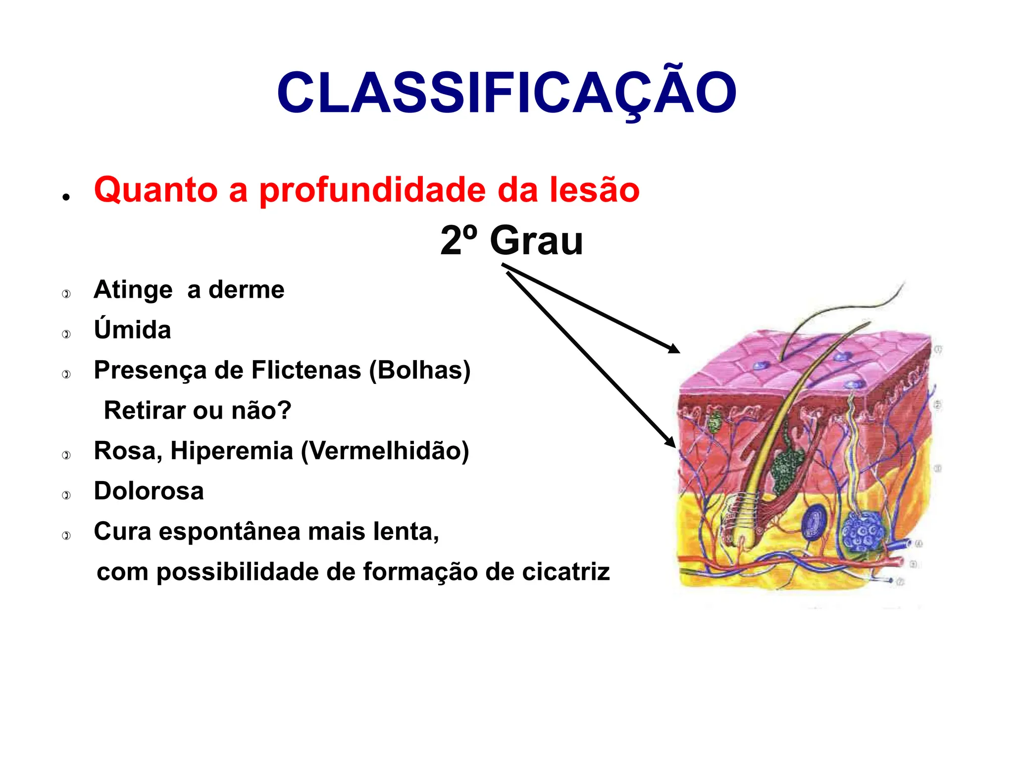 CLASSIFICAÇÃO
● Quanto a profundidade da lesão
2º Grau
 Atinge a derme
 Úmida
 Presença de Flictenas (Bolhas)
Retirar ou não?
 Rosa, Hiperemia (Vermelhidão)
 Dolorosa
 Cura espontânea mais lenta,
com possibilidade de formação de cicatriz
 