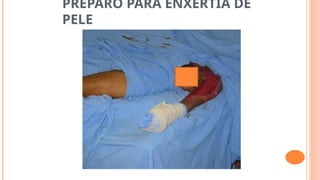 PREPARO PARA ENXERTIA DE
PELE
 