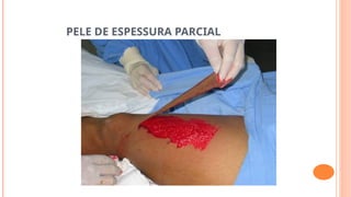 PELE DE ESPESSURA PARCIAL
 