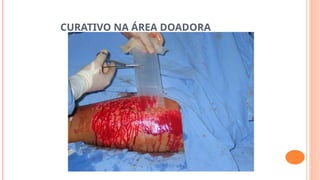 CURATIVO NA ÁREA DOADORA
 