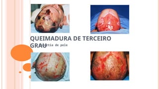QUEIMADURA DE TERCEIRO
GRAU
Enxertia de pele
 