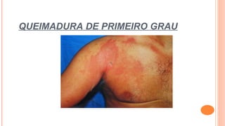 QUEIMADURA DE PRIMEIRO GRAU
 