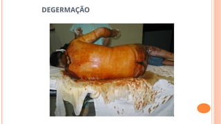 DEGERMAÇÃO
 