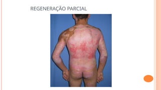 REGENERAÇÃO PARCIAL
 