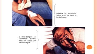 O olho atingido por
substância química
deve ser lavado com
bastante água.
Retirada da substância
sólida antes de lavar o
local afetado.
 